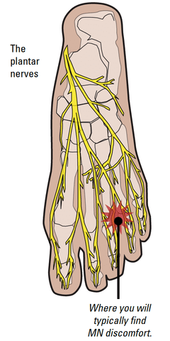 Illustration of nerves in the foot with indicators of where Morton’s Neuroma takes effect