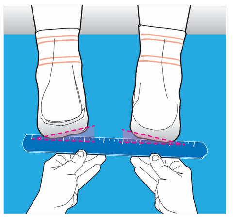 Illustration of feet with a varus tilt