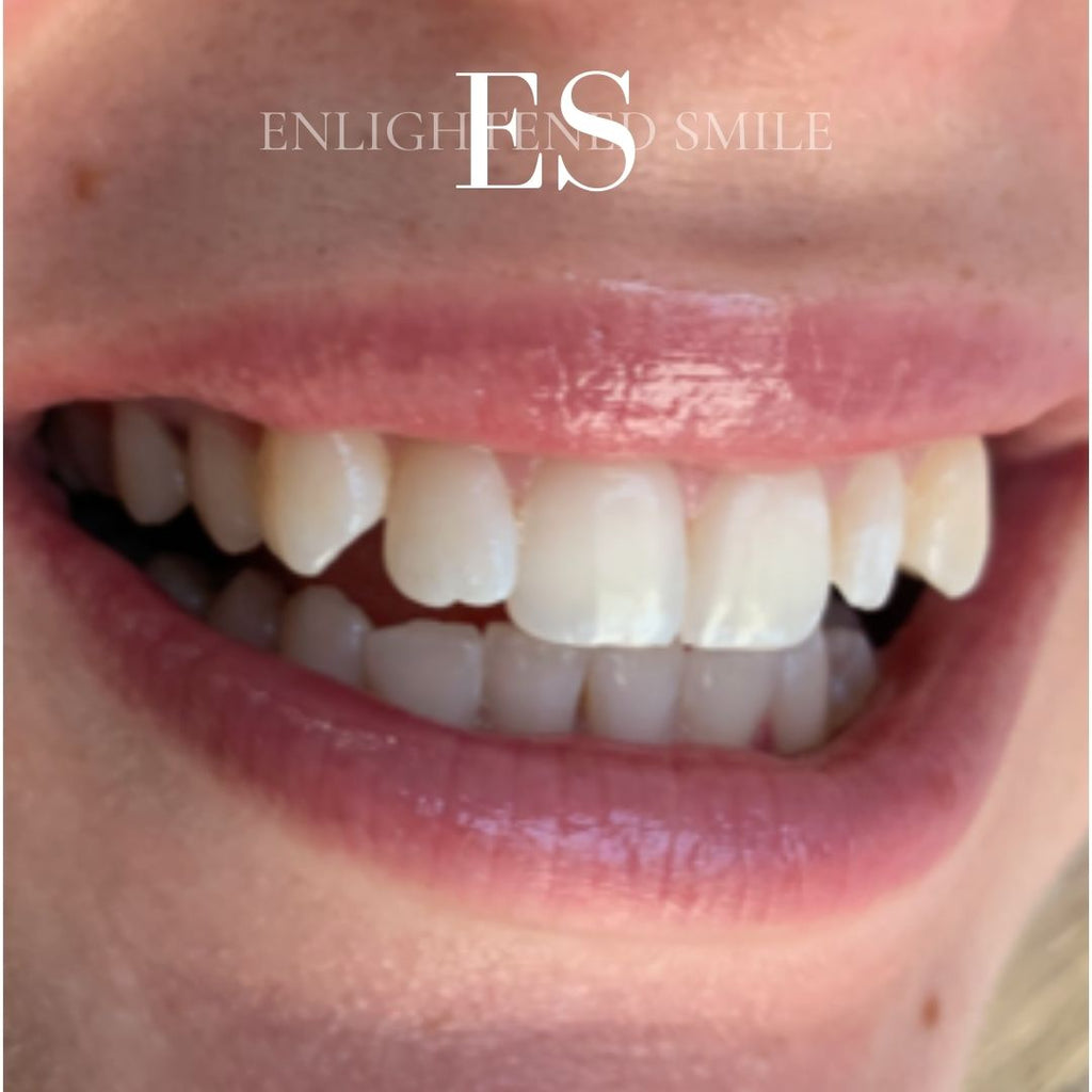 L POP Tooth Gem Adhesive – Enlightened Smile
