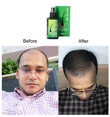 Comparison of thinning hair before and after using Neo Hair Lotion.