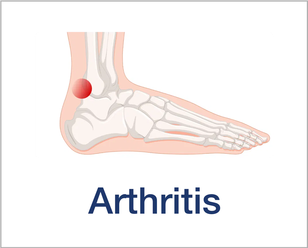 Illustration of arthritis in ankle joint, showing bone structure with red inflammation.
