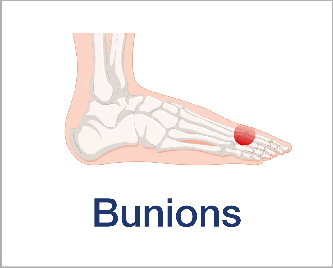 Medical illustration of a foot highlighting a bunion in red.