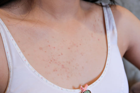 Teenage girl with acne on her chest