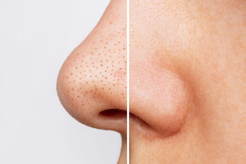 blocked pores on nose compared to unblocked pores