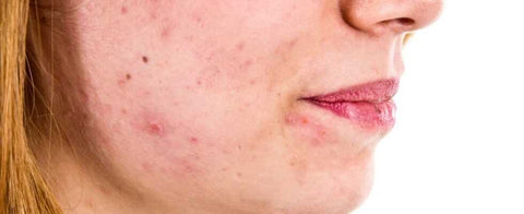 the various types of acne