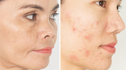 dark spots and acne