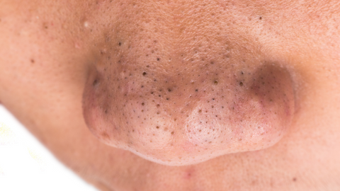 blackheads