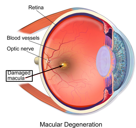 Macular Degeneration - eye image