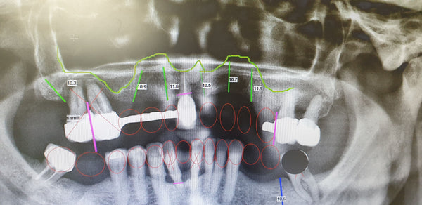  a 72 year old woman reported to the clinic with excessive tooth movement Xray with sketches
