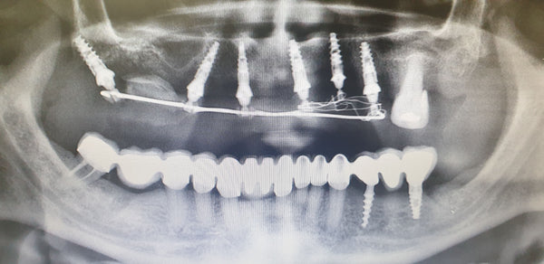 targeted teeth were extracted, milled, and prepared with the Comet method for autoaugmentation