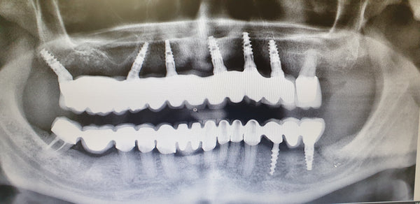 Clinical Case xray image of 8 GDT Dental Implants Oral Surgery