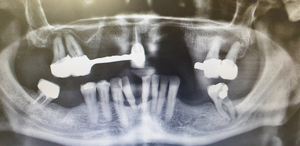  a 72 year old woman reported to the clinic with excessive tooth movement Xray 