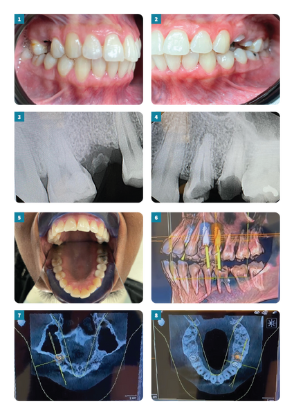 detailed steps of the replacement, and extraction of the broken teeth in images