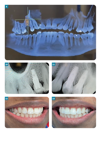 GDT Dental Implants on both sides of the Maxilla final result