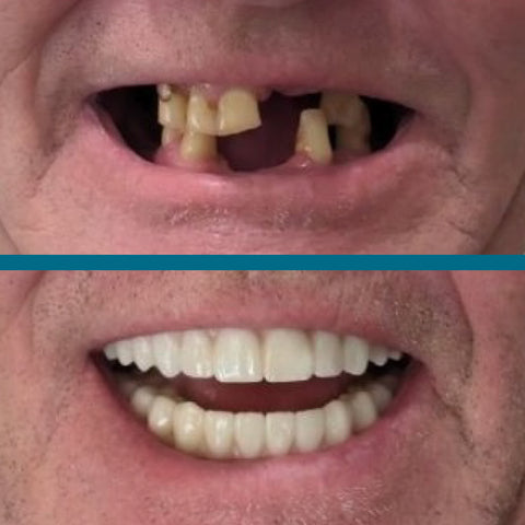 patients closeup before and after wide smile final result
