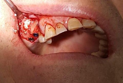 Adding GDT Synthetic Bone Graft for sinus augmentation