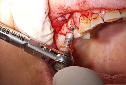 GDT Spiral Implant installation with 35 Ncm torque ratchet