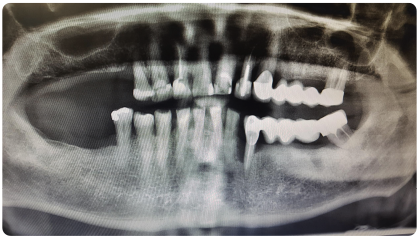 X-ray of a patient missing teeth on the upper right side