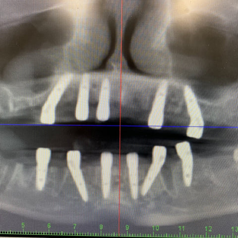 Full-Arch Rehabilitation using GDT dental implants