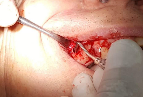 2. Pushing and removing Schnaiderian membrane