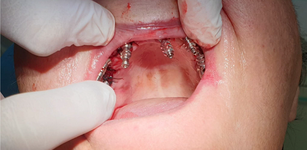 GDT dental impression coping in patients mouth