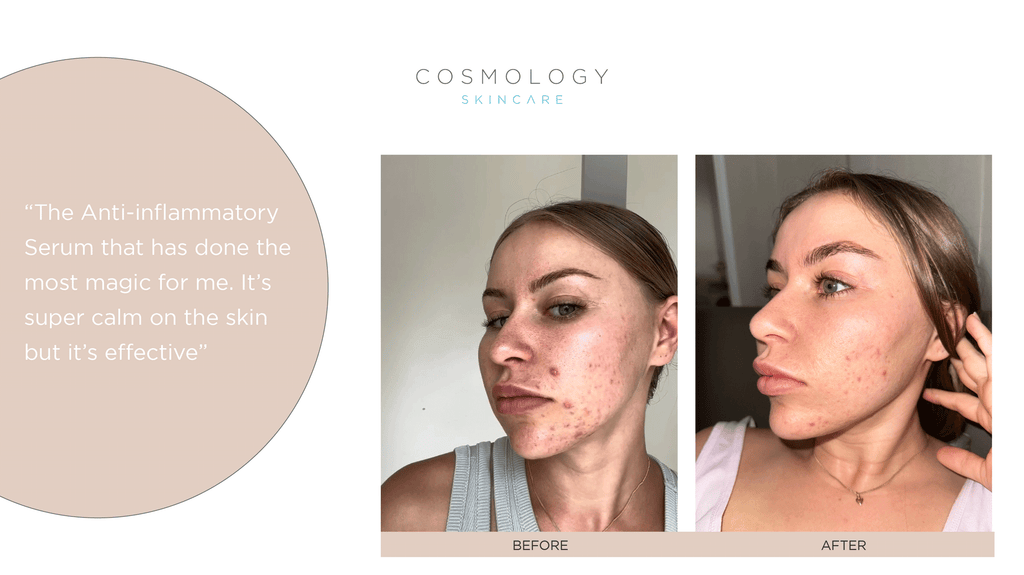 Before & After of Natalie's skin - the results are incredible!