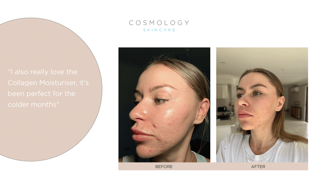 Natalie's results are due to commitment and quality products - shop Cosmology Skincare