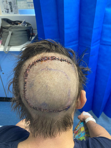 Craig's scar after surgery