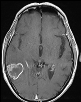 Brain scan showing a GBM tumour