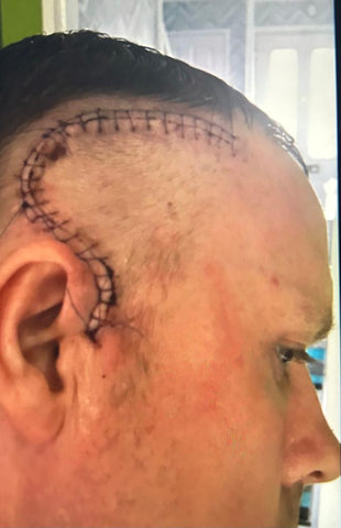 Paul's scar after surgery