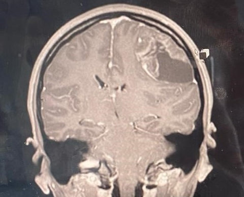 Tianna's scan showing the brain tumour