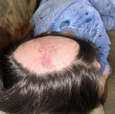 Tianna was left with a bald patch after treatment