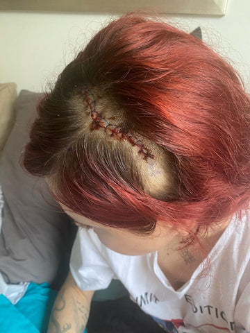 Tianna's scar after surgery