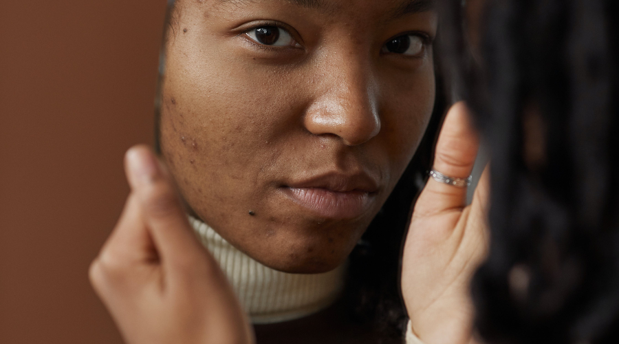 African American woman with acne looking in mirror