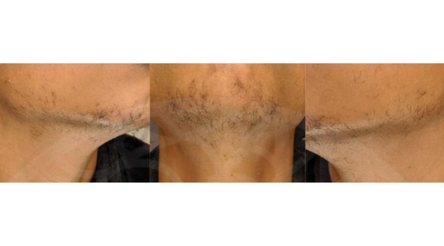 before and after of woman using facial hair removal oil