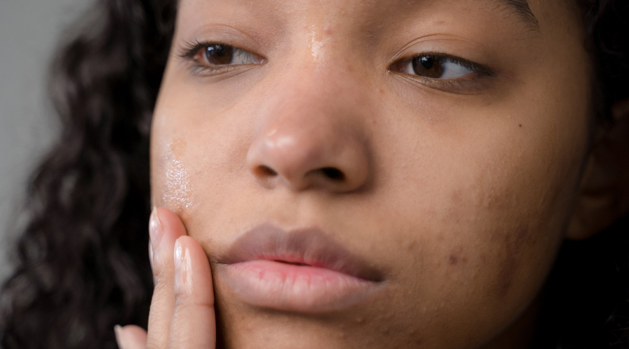 woman with hyperpigmentation on face
