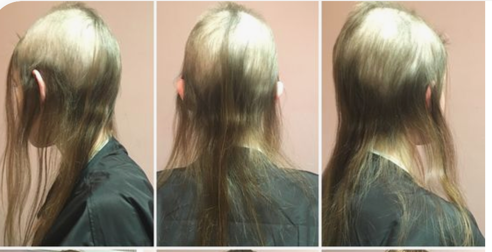 Trichotillomania hair plucking disease  DoçDrEkrem Civas