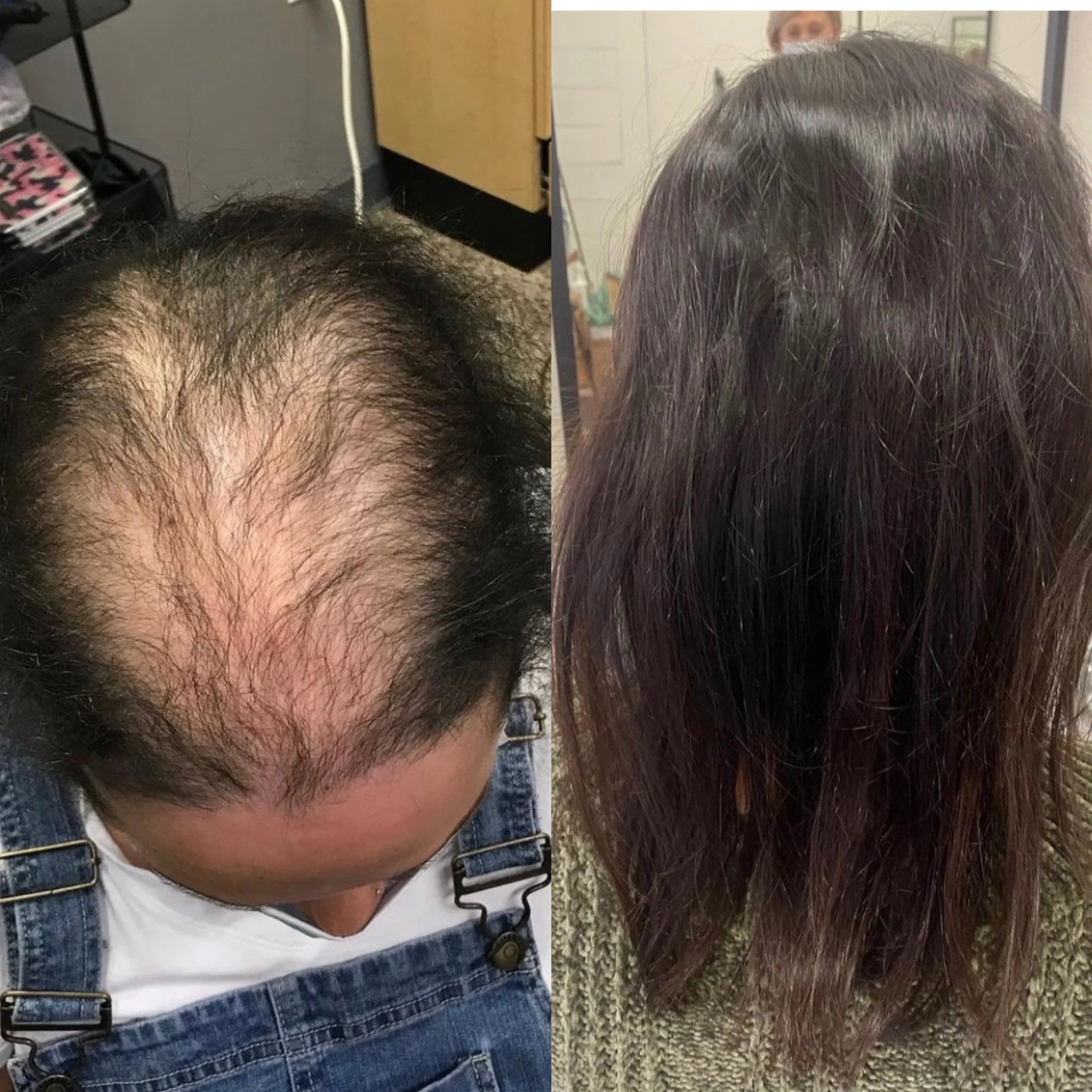 Androgenetic Alopecia | HAIR & SKIN Blog - HAIR & SKIN