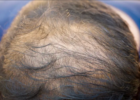 Scalp treatment for hair thinning
