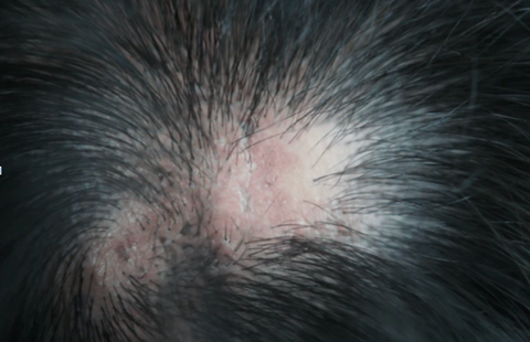 Lichen Planopilaris hair loss scalp