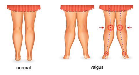 knee valgus