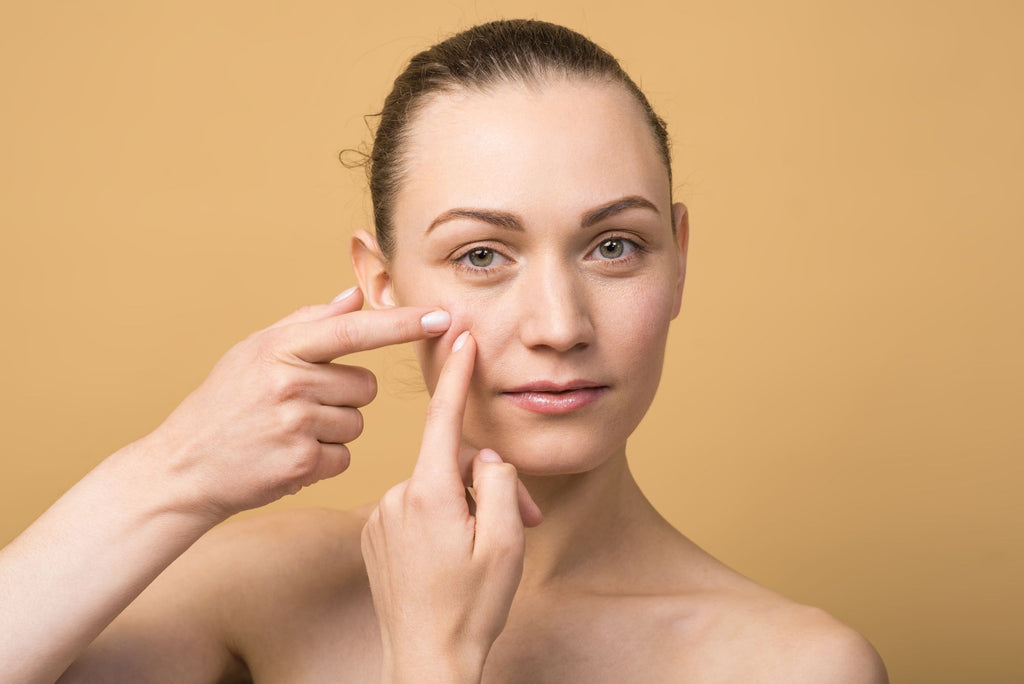 Avoid Picking and Popping to Prevent Acne Scars From Forming With Proper Blemish Care