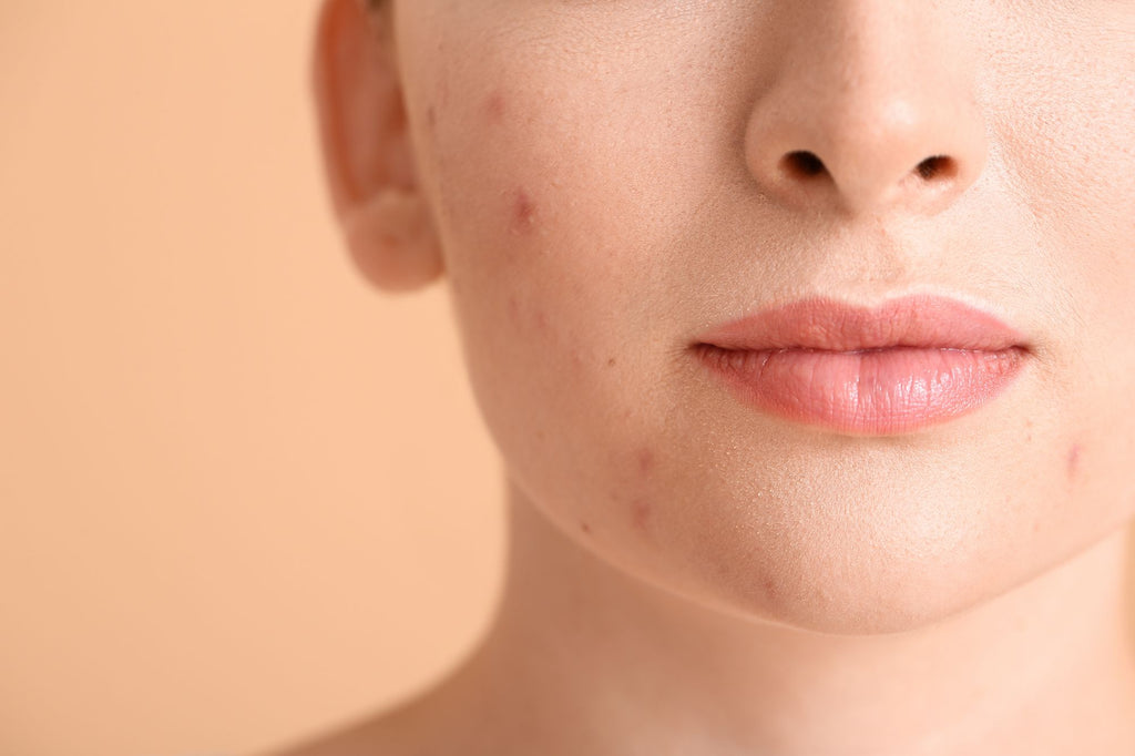 Prevent Acne Scars Tips From Forming With Proper Blemish Care