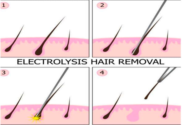 electrolysis hair removal for Men