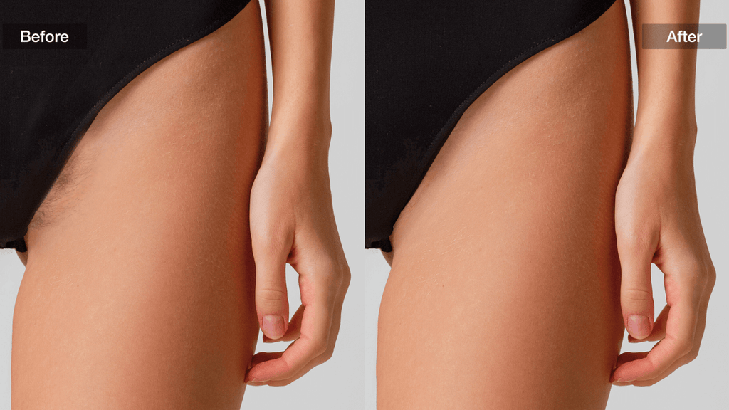 Close-up comparison of skin before and after Brazilian IPL hair removal therapy.