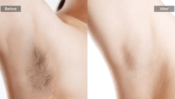 Before and after images showing the effectiveness of IPL hair removal on underarm hair.
