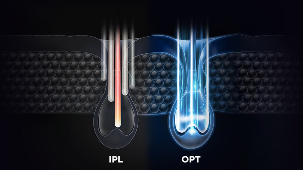Comparative illustration of IPL and OPT technology for hair removal sessions.