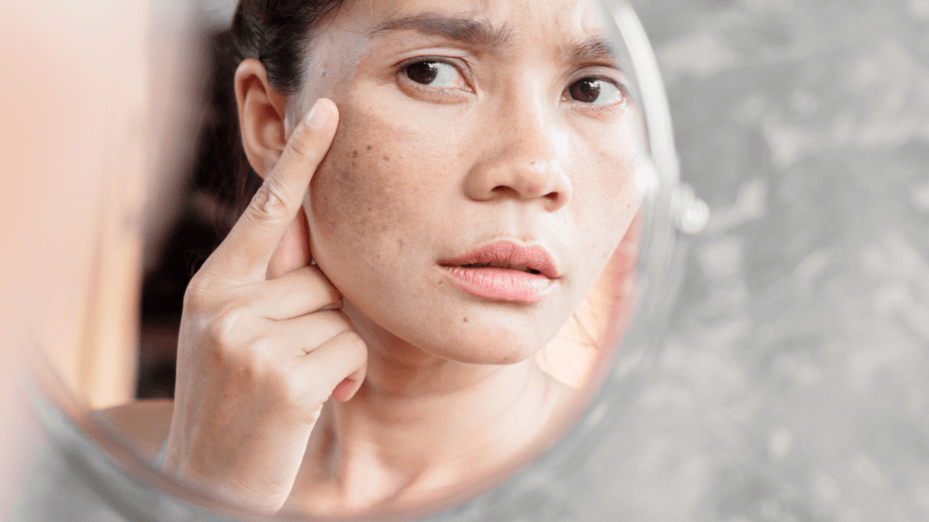 Concerned woman examining facial skin for hyperpigmentation in mirror after laser hair removal.