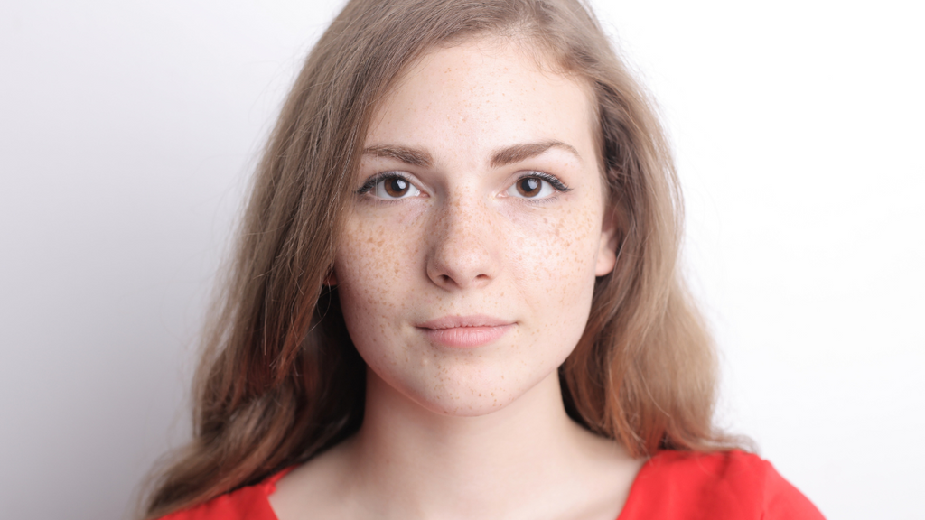 A young woman with sunspots on her face shows the effects of sun exposure.
