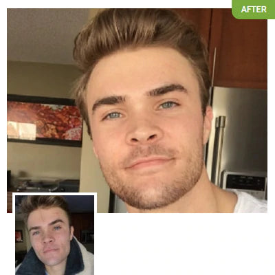 Before and after photos of someone who cleared their acne using Exposed.